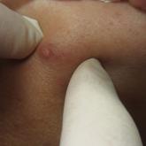 Cystic Presentation of High-Grade Ductal Carcinoma In Situ in an Inframammary Accessory Nipple