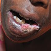 An African woman with an SCC on the lower lip decades after a large facial burn, which is known as a Marjolin ulcer.