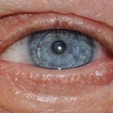 A flesh-colored papule on the left lower eyelid margin diagnosed as an endocrine mucin-producing sweat gland carcinoma (case 2).