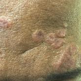 Erythematous to violaceous, flat papules and small plaques with some scaling across the forehead in a patient with sarcoidosis. Erythematous to violaceous, flat papules and small plaques with some scaling across the forehead in a patient with sarcoidosis.