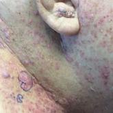Sharply demarcated, erythematous plaques studded with focally hemorrhagic, angiomatous papules on the neck and upper chest in a patient with cutaneous metastatic salivary duct carcinoma that originated from the parotid gland Sharply demarcated, erythematous plaques studded with focally hemorrhagic, angiomatous papules on the neck and upper chest in a patient with cutaneous metastatic salivary duct carcinoma that originated from the parotid gland