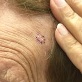Prior to biopsy, examination revealed an ill-defined, fleshcolored to white, smooth plaque on the left forehead Prior to biopsy, examination revealed an ill-defined, fleshcolored to white, smooth plaque on the left forehead