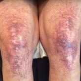 The addition of sclerotherapy to pulsed dye laser therapy showed a decrease in telangiectases and smaller patches after 2 years.
