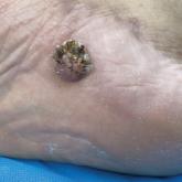 Verrucous plaque on the foot