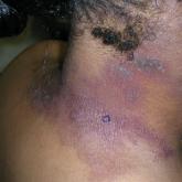 Black woman with ACD on the neck