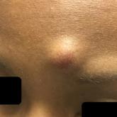 A well-circumscribed nodule on the left inferior frontal scalp with overlying erythema and no prominent follicular ostia