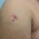 Pediatric Primary Cutaneous Marginal Zone Lymphoma Treated With Doxycycline