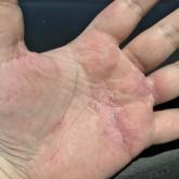 Near-complete resolution of dyshidrotic eczema with dupilumab. Near-complete resolution of dyshidrotic eczema with dupilumab.