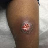 Pyoderma gangrenosum on the right posterior leg. Pyoderma gangrenosum on the right posterior leg.