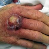 Ulcerating nodule on the dorsal aspect of the right hand with surrounding inflammation.