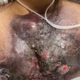 Large indurated plaque on the chest with ulceration and necrosis