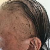 Hair loss Hair loss