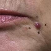 Multiple New-Onset Pyogenic Granulomas During Treatment With Paclitaxel and Ramucirumab