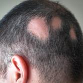 Androgenetic Alopecia: What Works?
