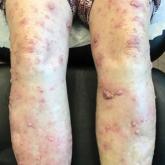 Clinical presentation of well-differentiated cutaneous squamous cell carcinoma, keratoacanthoma type, on the arms and legs, respectively, with widespread red, tender, scaly papules and nodules. Clinical presentation of well-differentiated cutaneous squamous cell carcinoma, keratoacanthoma type, on the arms and legs, respectively, with widespread red, tender, scaly papules and nodules.