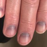 Blue to slate gray discoloration of the proximal fingernails