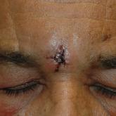Superficial Vascular Anomaly of the Glabella Mimicking a Cutaneous Cyst