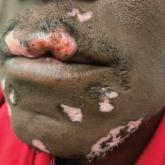 Invasive squamous cell carcinoma arising within a labial discoid lupus erythematosus lesion. This patient’s lesions were present for approximately 6 years prior to presentation for carcinoma