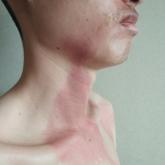 Burning skin patches on the face, neck, and chest