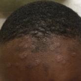 Scattered annular papulosquamous eruptions were present on the forehead, with postinflammatory hyperpigmentation in areas following resolution of prior plaques.