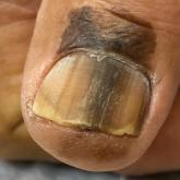 Melanoma manifesting as LM with a prominent Hutchinson sign in a Hispanic man, with variable shades of brown covering more than 50% of the nail width.