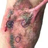 Annular verrucous plaque with central hypopigmentation extending from the medial right leg to the posterior right thigh with keloid formation at the proximal edge.