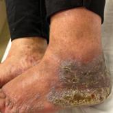 Lichenoid dermatosis on the feet