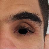 Periorbital hyperpigmentation on the left side; hypertrichosis and eyelash trichomegaly compared to the right side