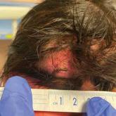 Occipital scalp nodule in a newborn