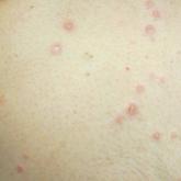 Clinical Manifestation of Degos Disease: Painful Penile Ulcers