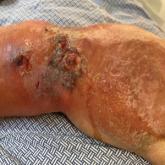 Necrotizing myositis of the right hand and forearm with diffuse redness, erythema, and edema surrounding a large necrotic ulceration with purulent debris.