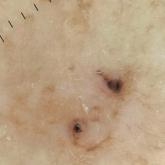 Pigmented Lesion on the Left Shoulder in an Older Woman