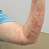 Cyclosporine for Recalcitrant Bullous Pemphigoid Induced by Nivolumab Therapy for Malignant Melanoma