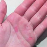 Isotretinoin-Induced Skin Fragility in an Aerialist