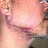 Blaschkolinear Lupus Erythematosus: Strategies for Early Detection and Management