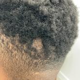 Hairless Scalp Lesion