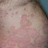 Treat-to-Target Outcomes With Tapinarof Cream 1% in Phase 3 Trials for Plaque Psoriasis