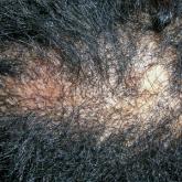 Central Centrifugal Cicatricial Alopecia