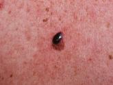 What’s new in the latest melanoma guidelines
