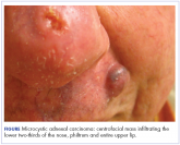 Resolution of refractory pruritus with aprepitant in a patient with microcystic adnexal carcinoma