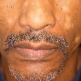 Facial Involvement in Progressive Macular Hypomelanosis