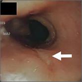 Critical anemia • light-headedness • bilateral leg swelling • Dx? 