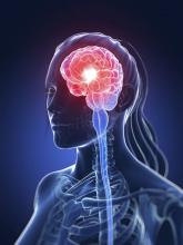 Cluster headache presents differently in never-smokers, survey finds