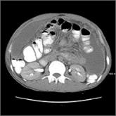 Immigrant with stomach pain, distension, nausea, and fever • Dx?