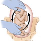 External cephalic version: How to increase the chances for success