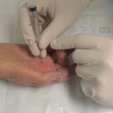 Percutaneous Release of Trigger Digits