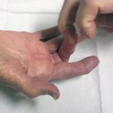 Percutaneous Trigger Finger Release