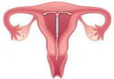 Reproductive planning for women after solid-organ transplant