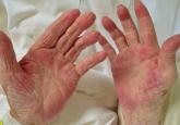 Palmar erythema as a sign of cancer