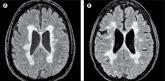 New MS subtype shows absence of cerebral white matter demyelination